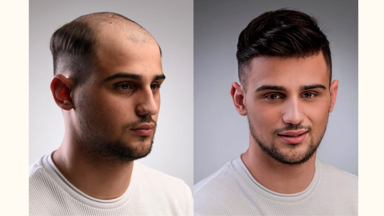 hair replacement for men